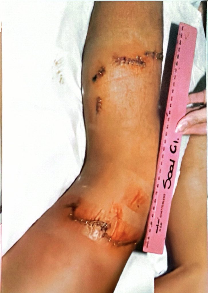 Shark Bite, 1996