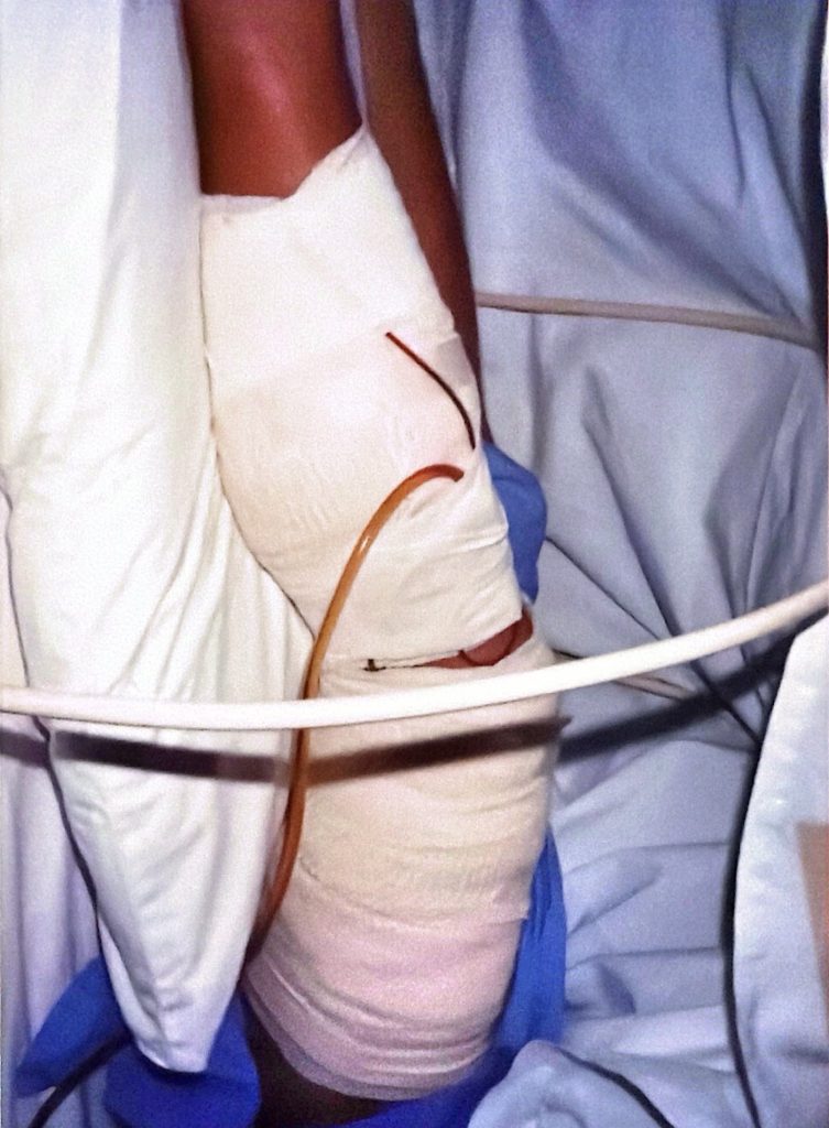 Shark Bite, 1996